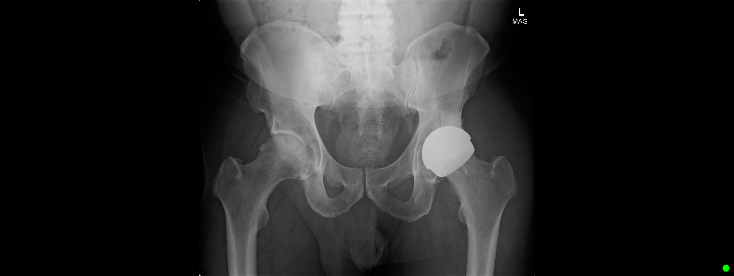 Post-operative X-ray of the left hip, showing the ceramic-on-ceramic resurfacing implant