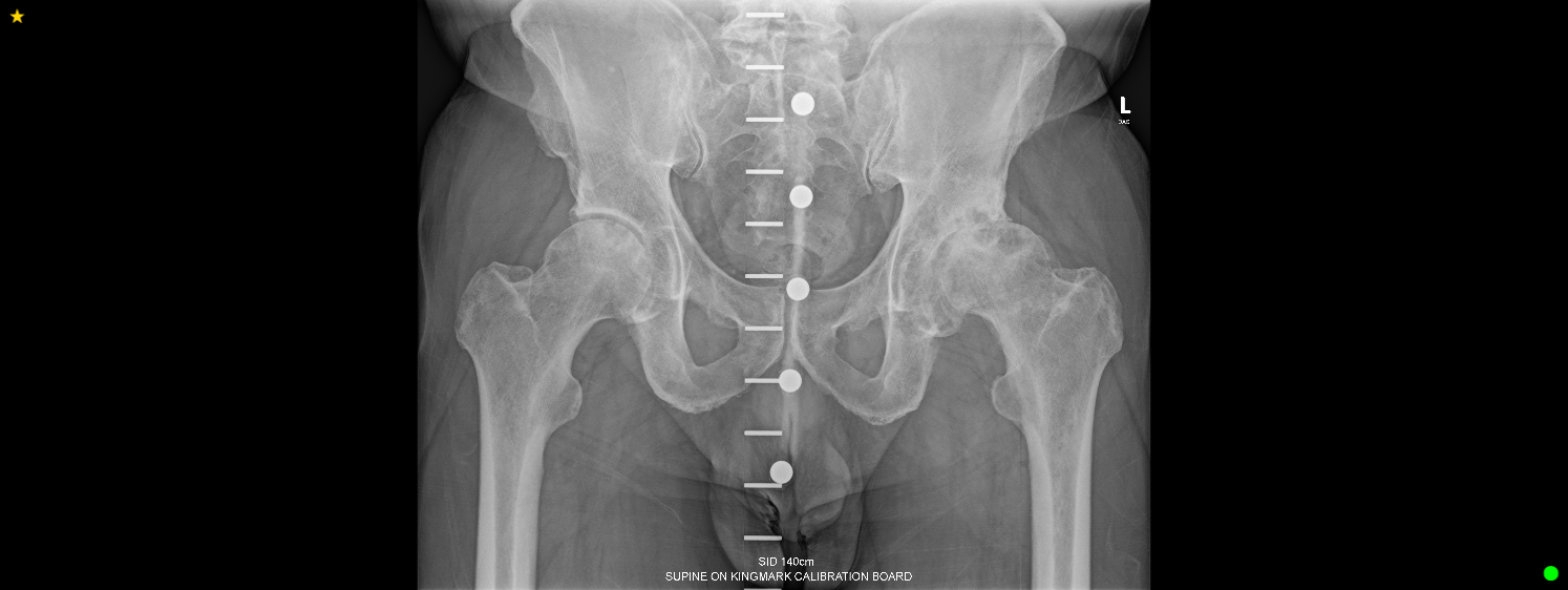 Pre-operative X-ray of the left hip, showing the joint before resurfacing