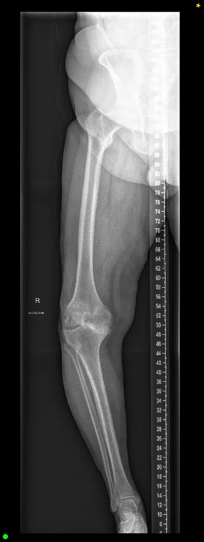 Pre-operative X-ray of the knee, showing the joint before replacement