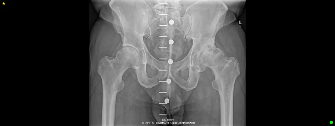 Pre-operative X-ray of the left hip, showing the joint before resurfacing