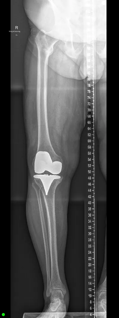 Post-operative X-ray of the knee, showing the knee replacement implant