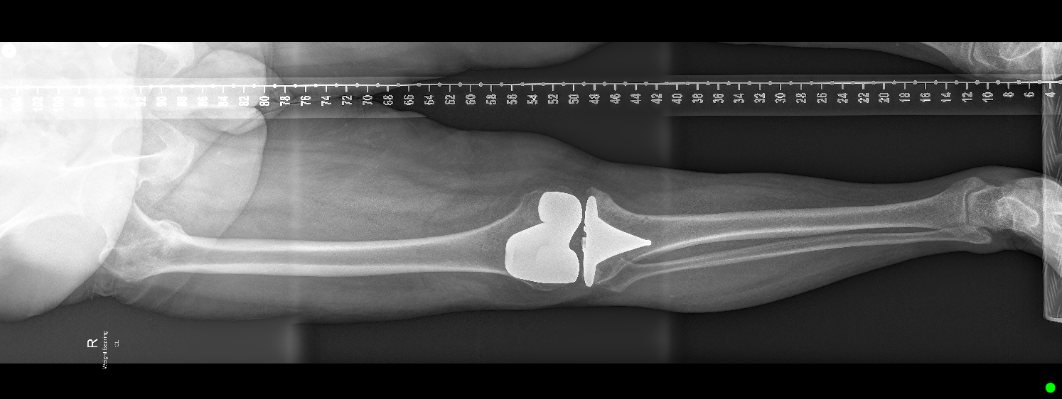 Post-operative X-ray of the knee, showing the knee replacement implant