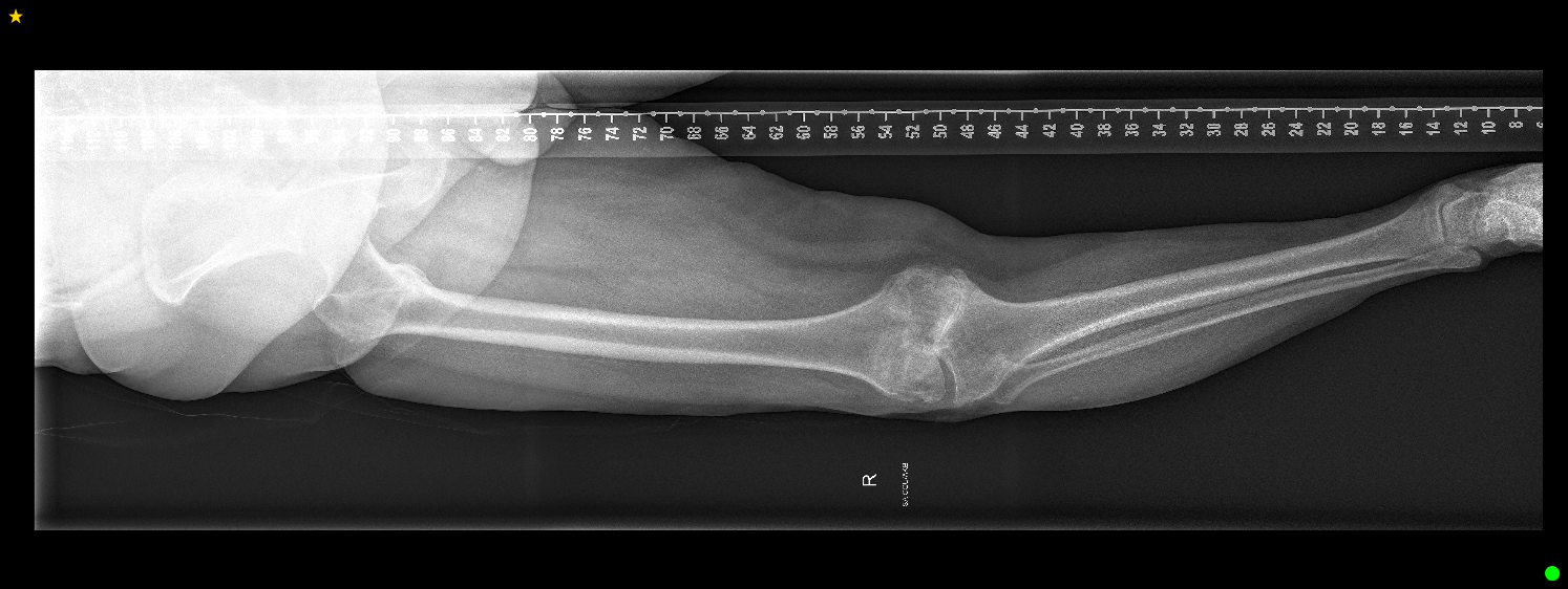 Pre-operative X-ray of the knee, showing the joint before replacement